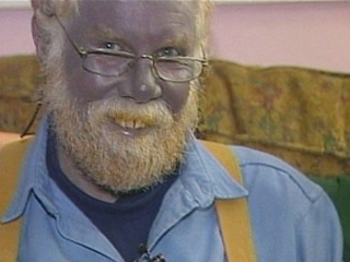 The Blue Man Syndrome | Silver Poisoning by Drinking Silver Made at Home